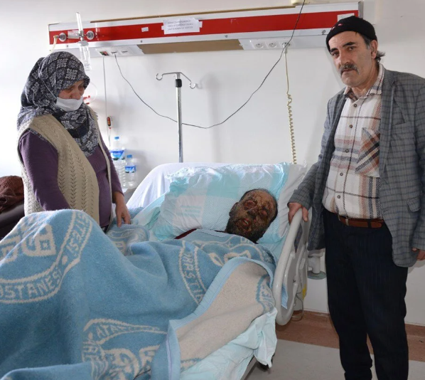 Koronavirusa yoluxduqdan sonra bədəni çürüməyə başladı - FOTOLAR